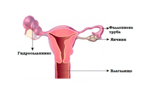 Гидросальпинкс при беременности