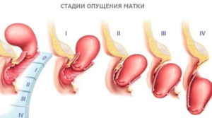 Пластика в гинекологии при опущении матки