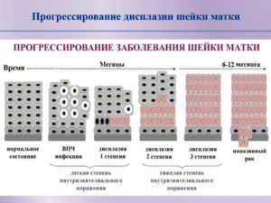 Легкая и тяжелая дисплазия шейки матки