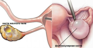 Функциональная киста правого и левого яичника
