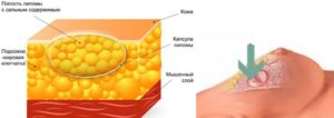 Жировик в грудной железе у женщин