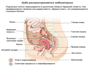 Симптомы эндометриоза кишечника