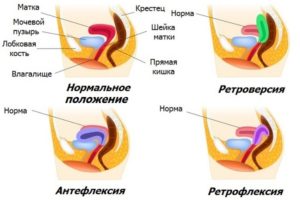 Что означает матка отклонена кзади