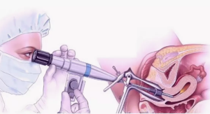 Гистероскопия и биопсия при миоме матки