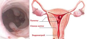 Причины возникновения полипа цервикального канала