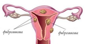 Что называют фиброзом матки