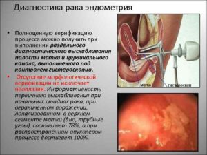 Диагностическое выскабливание полости матки при гиперплазии эндометрия