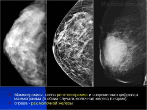 Как часто можно делать маммографию