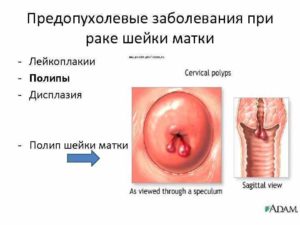 Лечение хронического цервикоза шейки матки