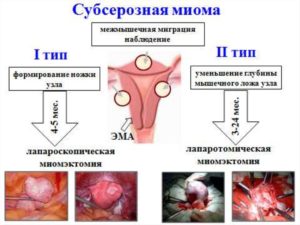 Лечение при субсерозном узле в матке