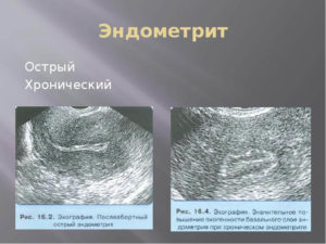 Что такое острый и подострый эндометрит