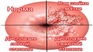 Инвазивный рак шейки матки