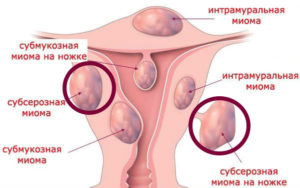 Лечение миомы матки небольших размеров