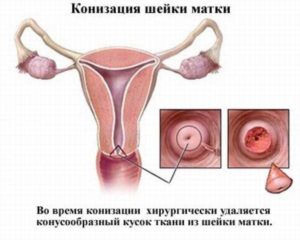 Последствия после диатермоконизации шейки матки