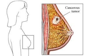 Опухоль в грудине у женщин