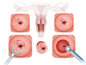 Что называют санацией шейки матки