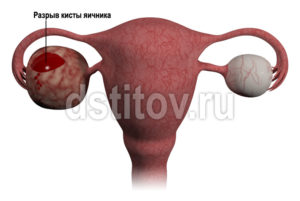 Разрыв кисты яичника