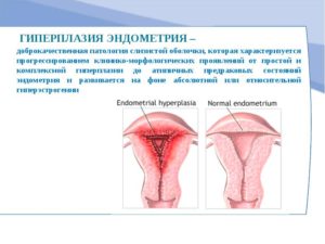 Как лечить гиперплазию эндометрия матки