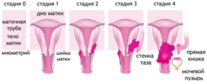 Стадии рака шейки матки