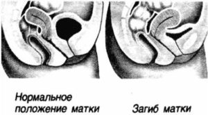 Причины, симптомы и лечение загиба шейки матки