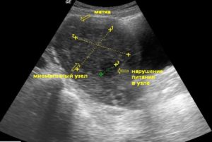 Когда делать УЗИ при миоме матки