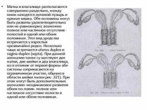 Две матки и две шейки матки