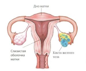 Киста (правого, левого) яичника:  лечение, последствия, фото