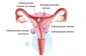 Как остановить рост миомы