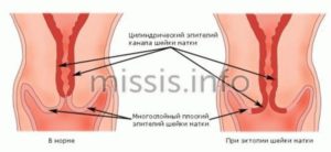 Эпителий шейки матки в норме