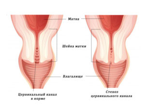 Цервикальный канал у женщин