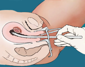 Половая жизнь после выскабливания