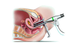 Как проводится гистероскопия эндометрия