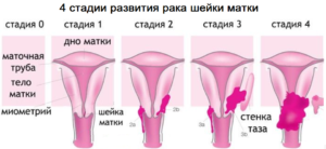 Первые признаки и симптомы рака шейки матки