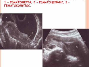 Что такое гематометра