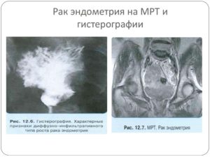 Симптомы и признаки рака эндометрия матки