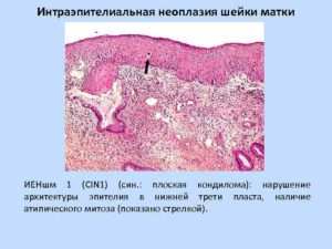 Неоплазия шейки матки