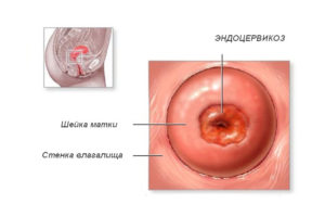 Что такое стационарный эндоцервикоз шейки матки