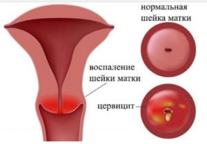 Цервицит шейки матки