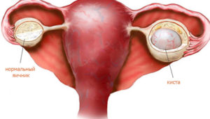 Эндометриоидная киста левого и правого яичника
