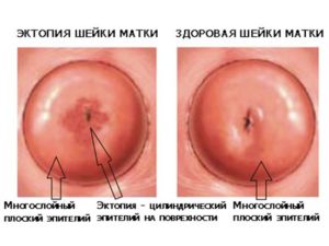 Эктопия цилиндрического эпителия шейки матки