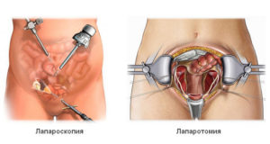 Лапаротомия кисты яичника