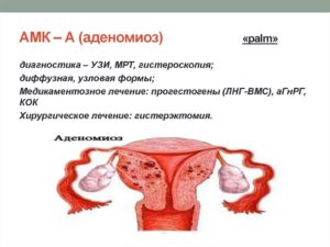 Что такое диффузный эндометриоз матки
