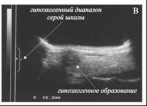 Что такое анэхогенное образование в шейке матки