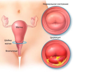 Эрозия шейки матки и цервицит