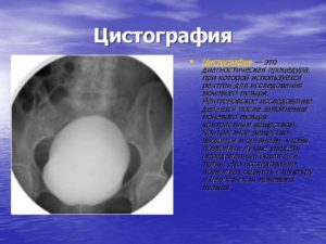 Цистограмма как делают детям