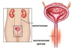 Спазм уретры у женщин