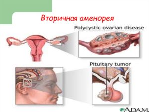 Вторичная аменорея у подростков