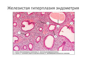 Что такое железистая гиперплазия эндометрия