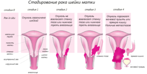 Карцинома шейки матки