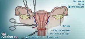 Удаление придатков у женщин последствия